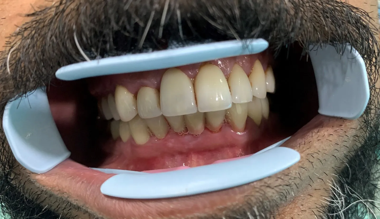 After: The same teeth after treatment: even, natural-looking upper and lower teeth with healthy gums
